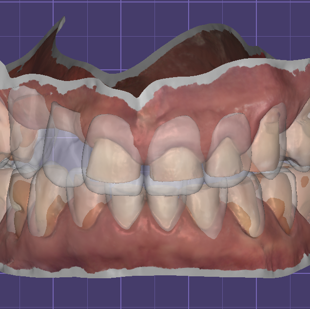 Virtual Digital Smile Design (DSD)