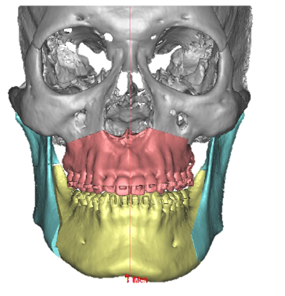 Surgical 3D simulation
