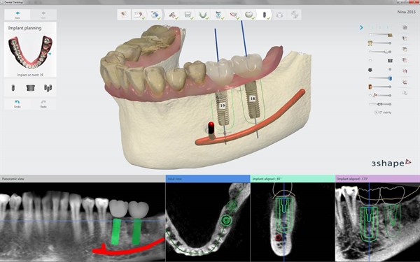 Digital Dental Implant Planning